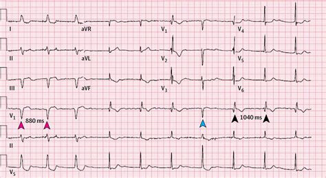 abnormal ekg results